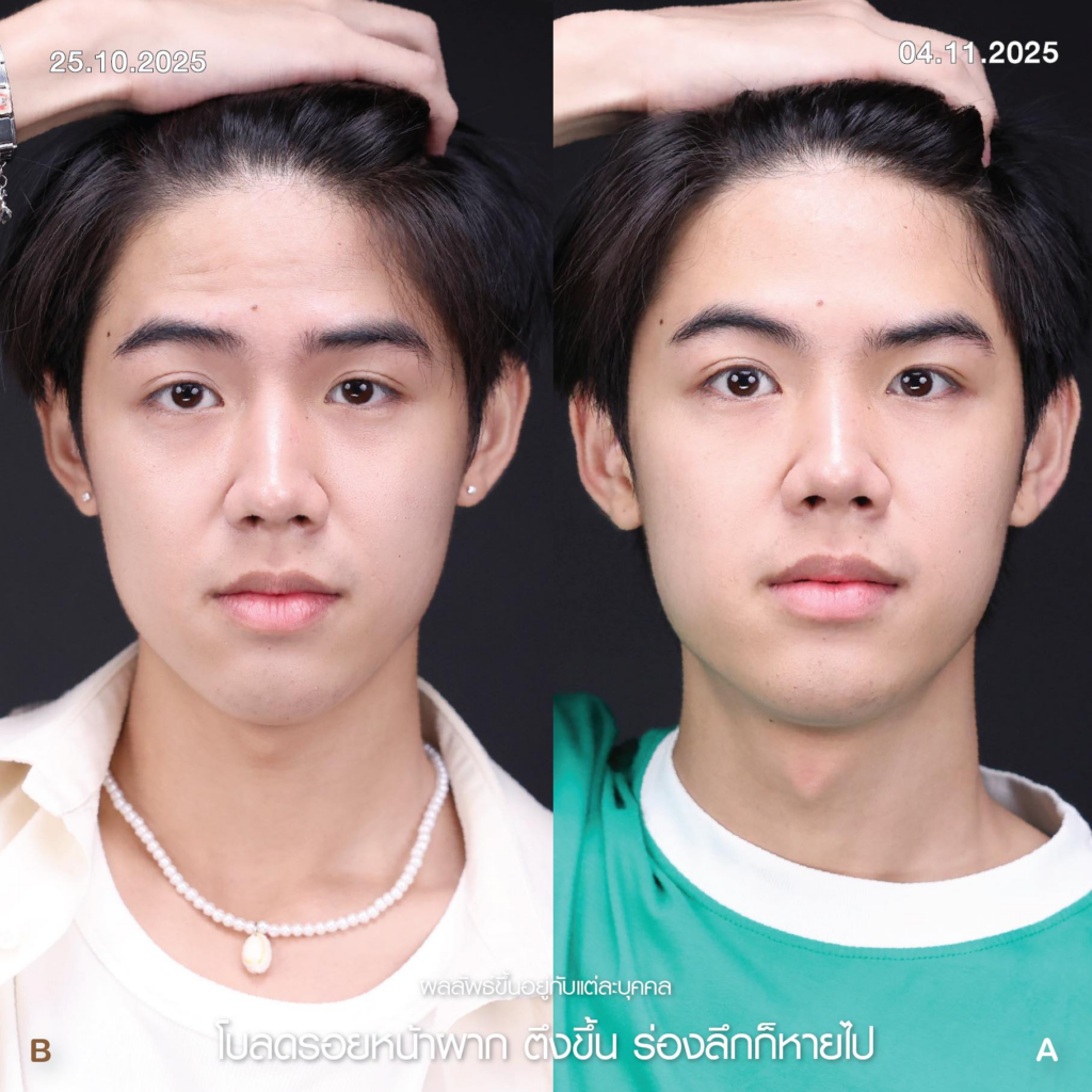 รีวิวคลินิกเสริมความงามขอนแก่นที่ Elite Clinic