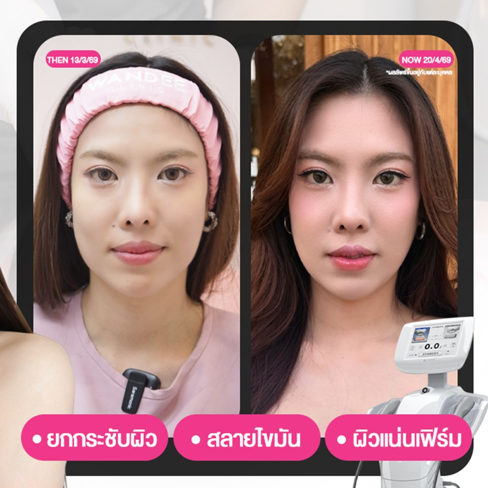 รีวิวคลินิกเสริมความงามสกลนครที่ Wandee Clinic
