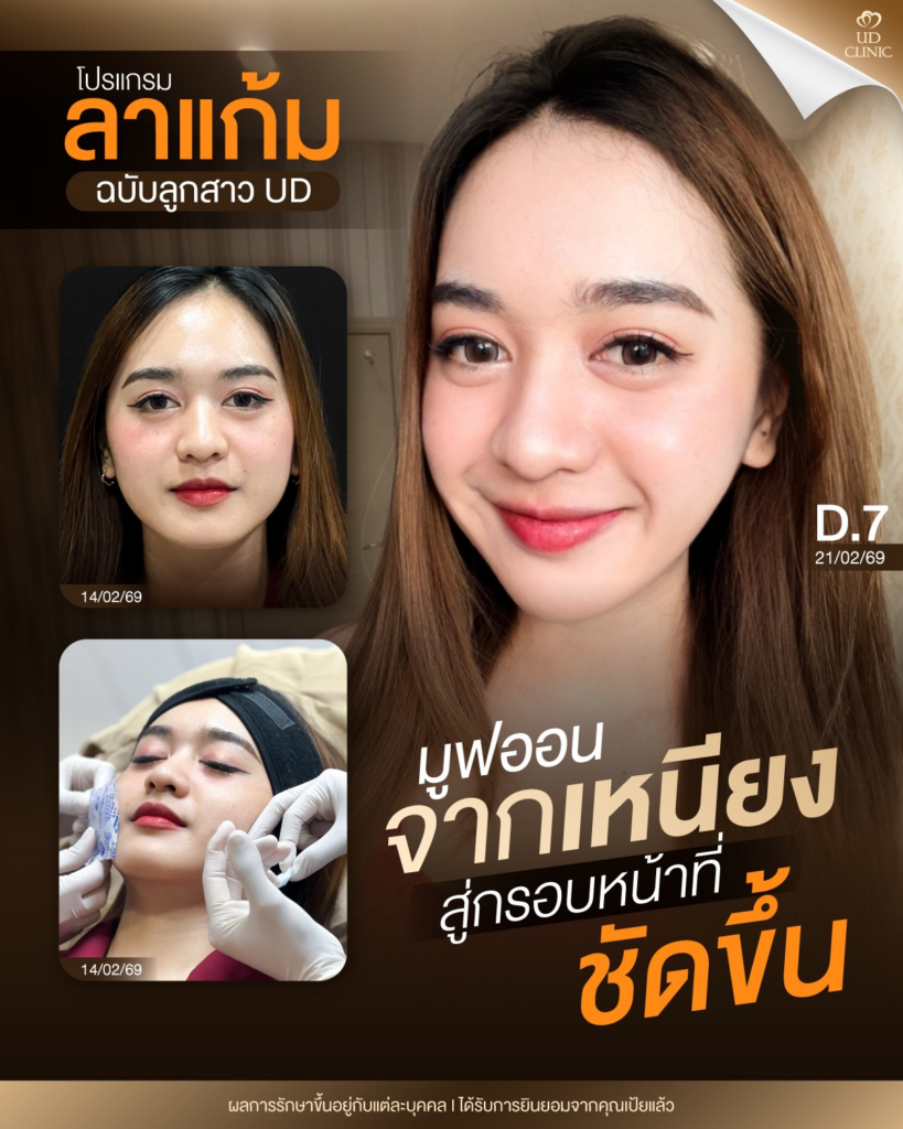 รีวิวคลินิกเสริมความงามขอนแก่นที่ UD Clinic Khonkaen