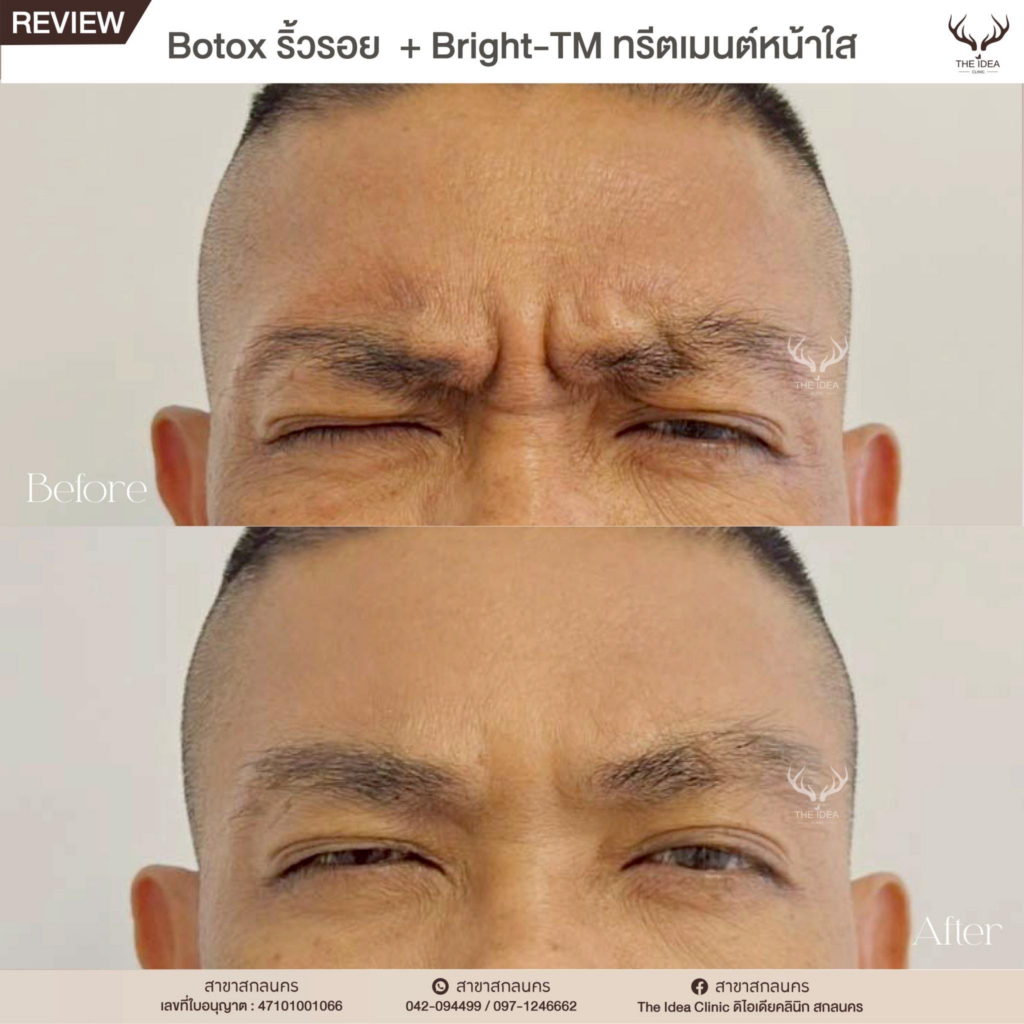 รีวิวคลินิกเสริมความงามสกลนครที่ The Idea Clinic
