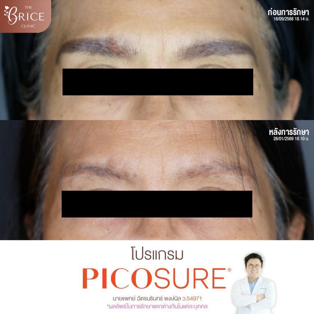 รีวิวคลินิกเสริมความงามสกลนครที่ The Brice Clinic