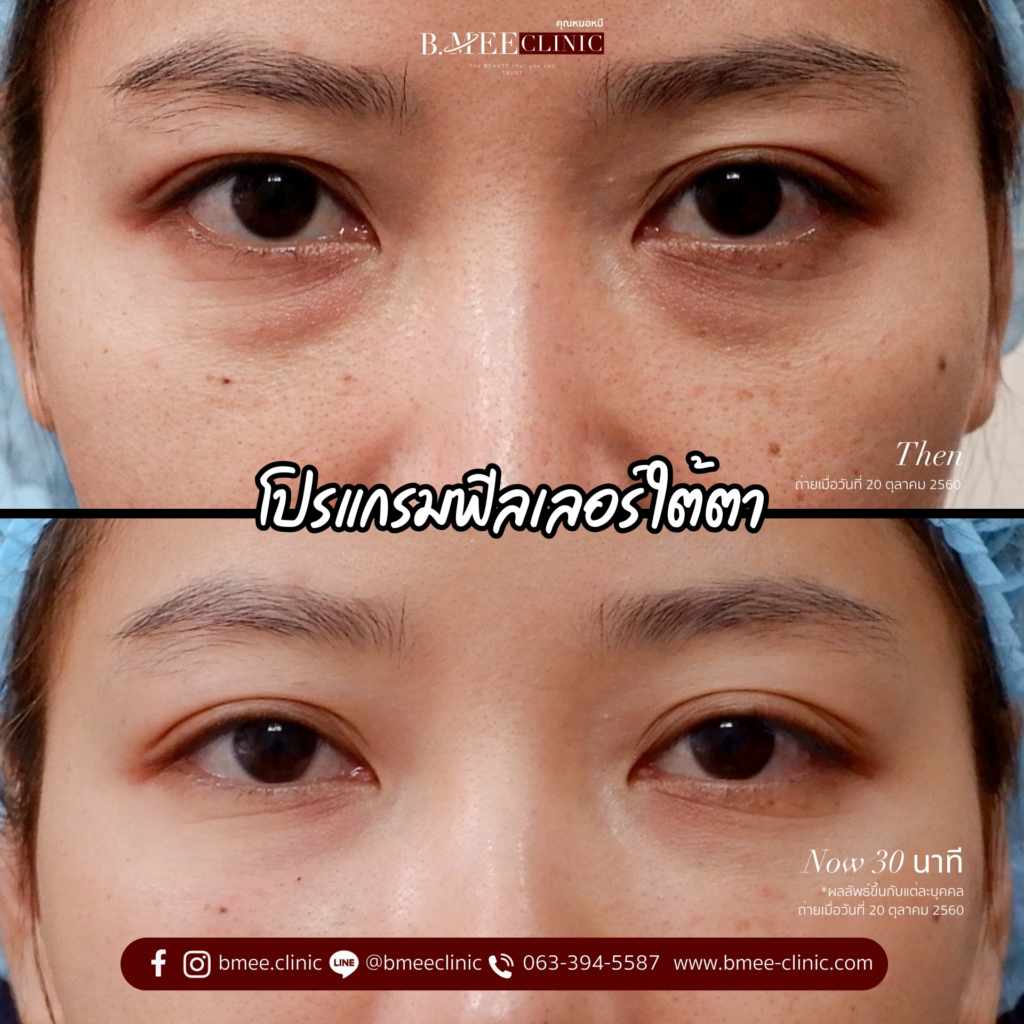 รีวิวคลินิกเสริมความงามขอนแก่นที่ บ้านหมีคลินิก