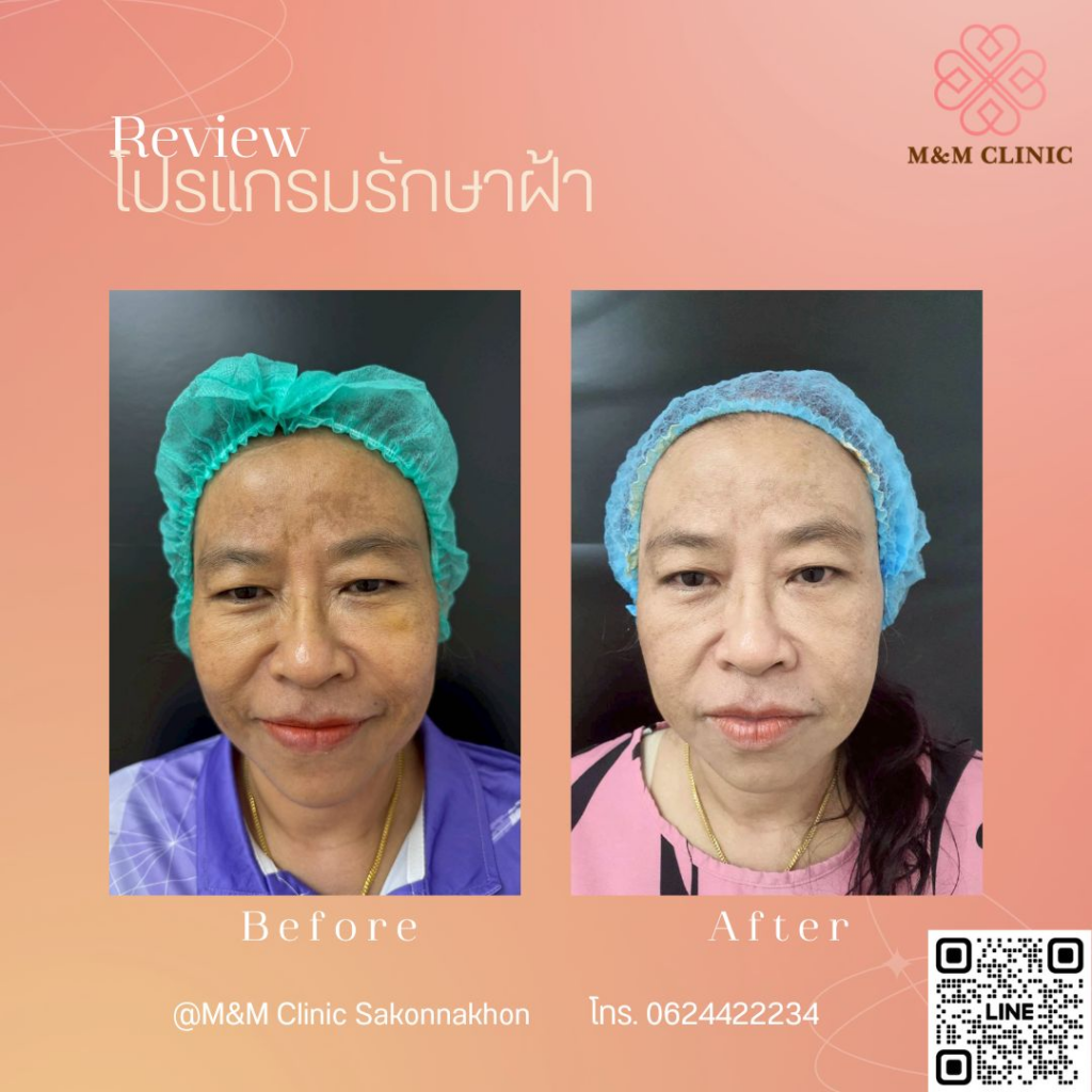 รีวิวคลินิกเสริมความงามสกลนครที่ M&M Clinic