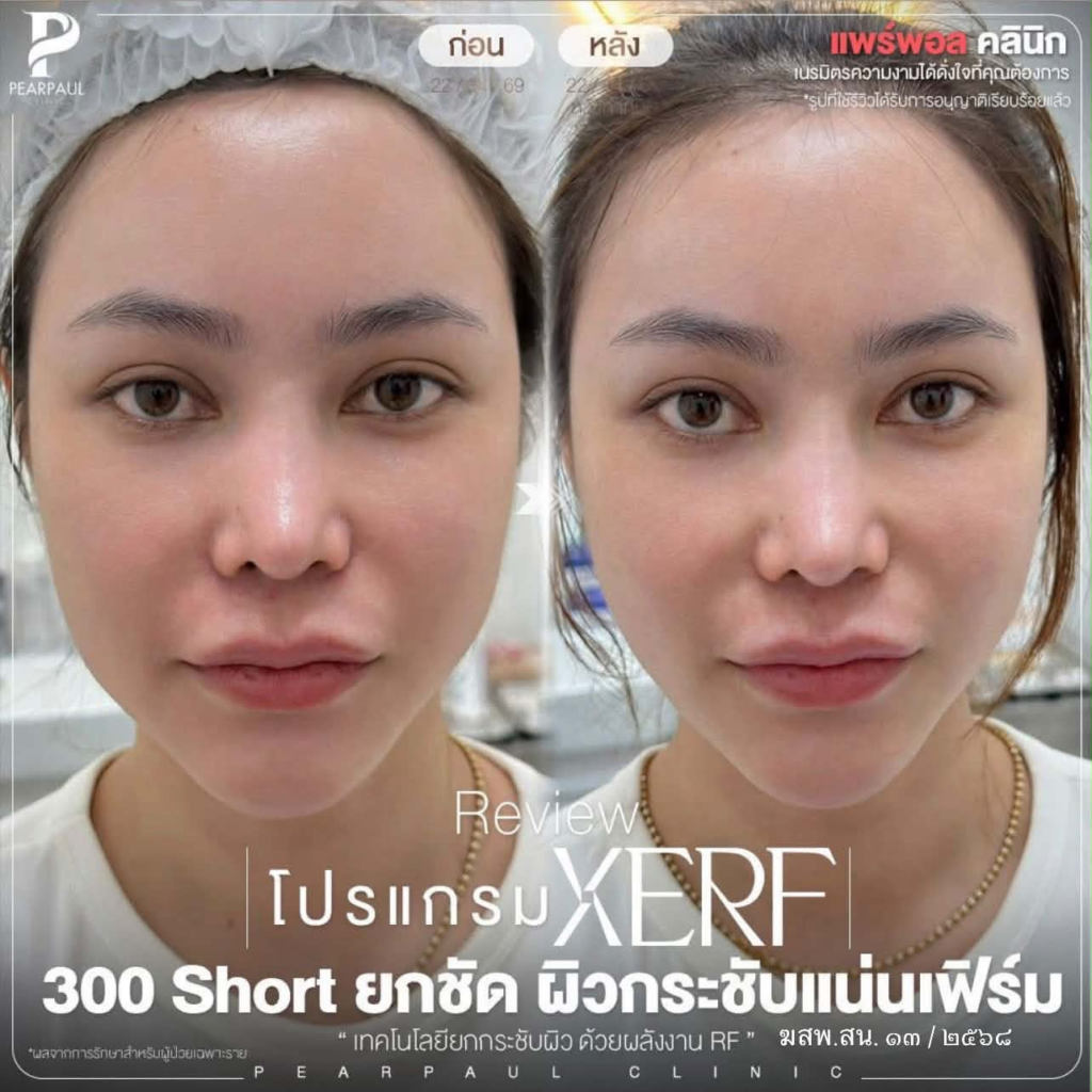 รีวิวคลินิกเสริมความงามสกลนครที่ Pearpaul Clinic