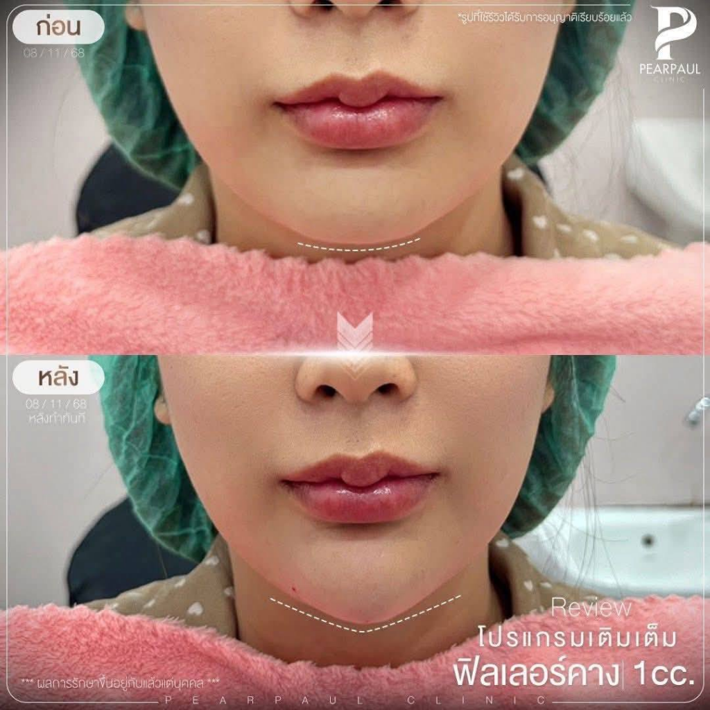รีวิวคลินิกเสริมความงามสกลนครที่ Pearpaul Clinic