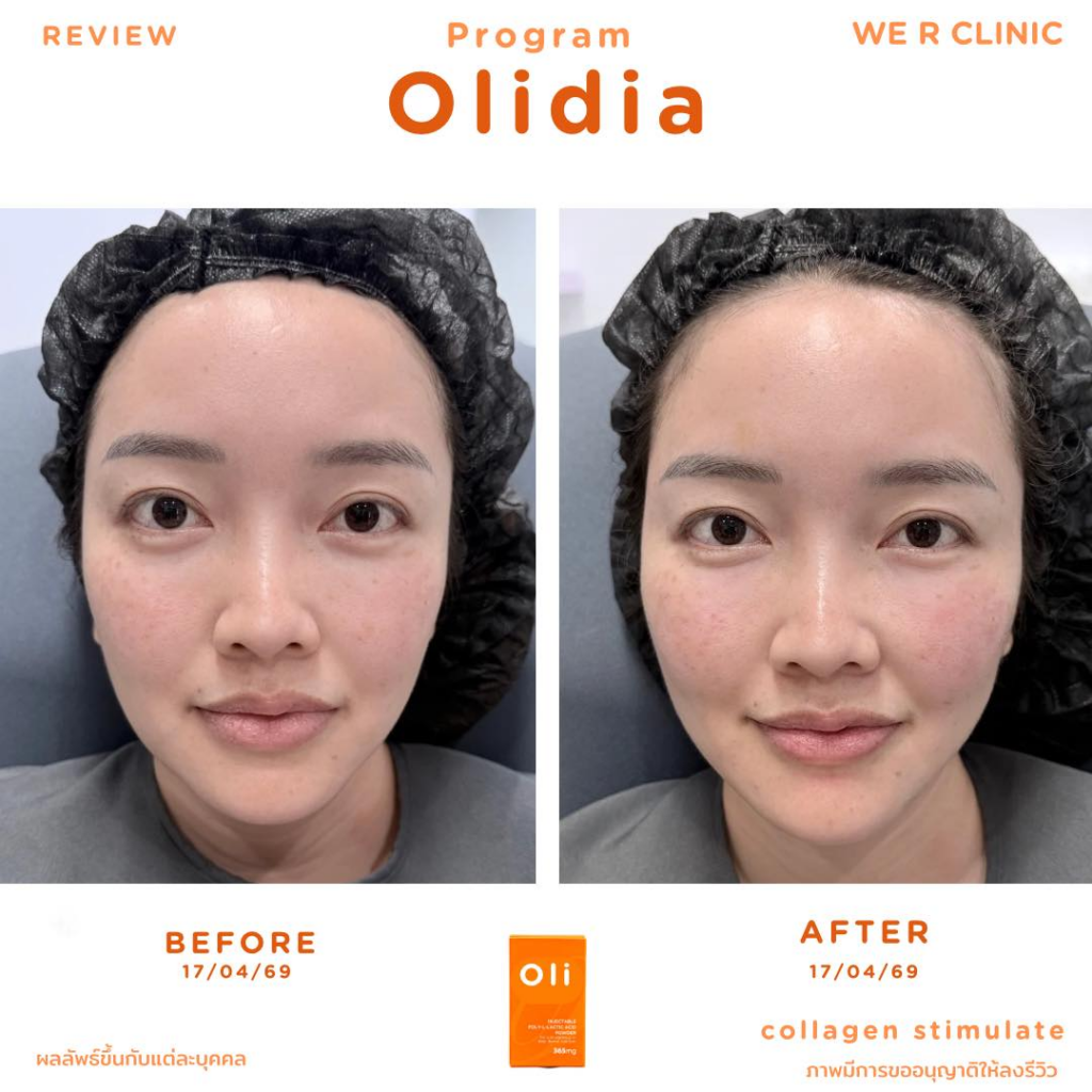รีวิวคลินิกเสริมความงามกาฬสินธุ์ที่ We R Clinic