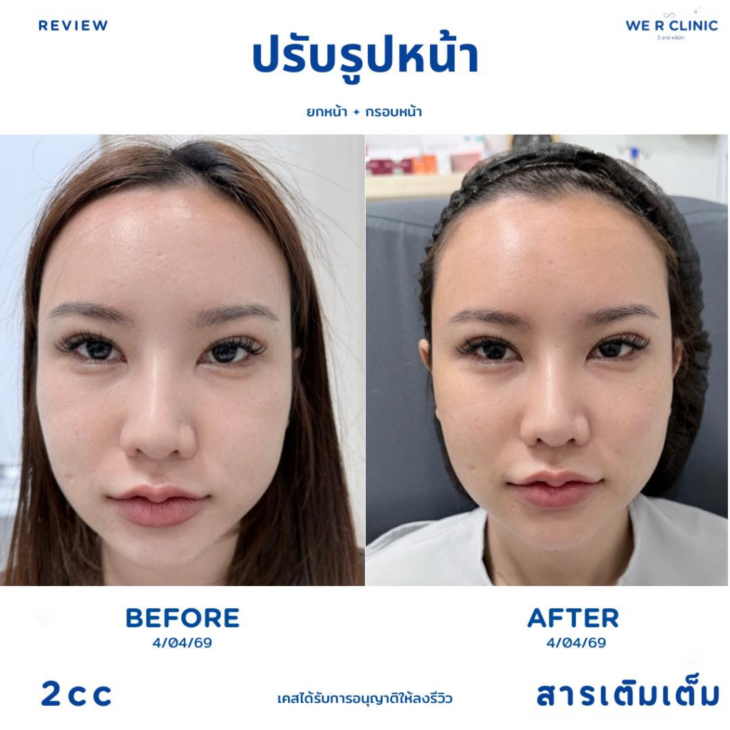 รีวิวคลินิกเสริมความงามกาฬสินธุ์ที่ We R Clinic