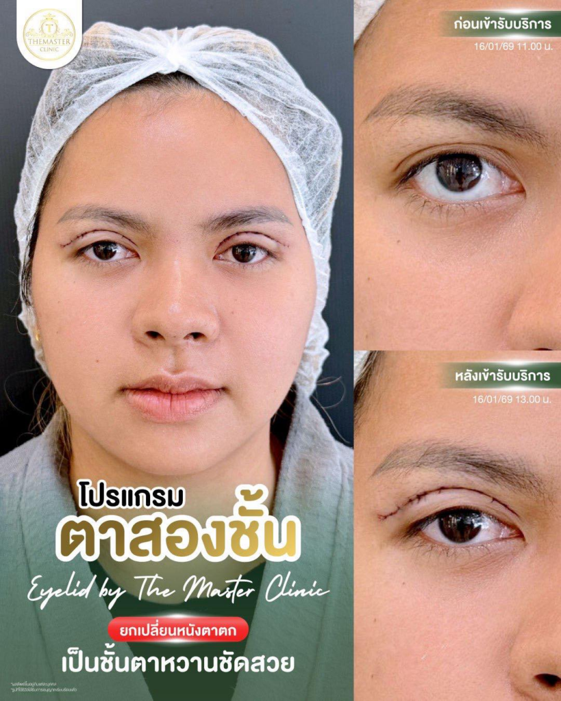 รีวิวคลินิกเสริมความงามกาฬสินธุ์ที่ Themaster Clinic