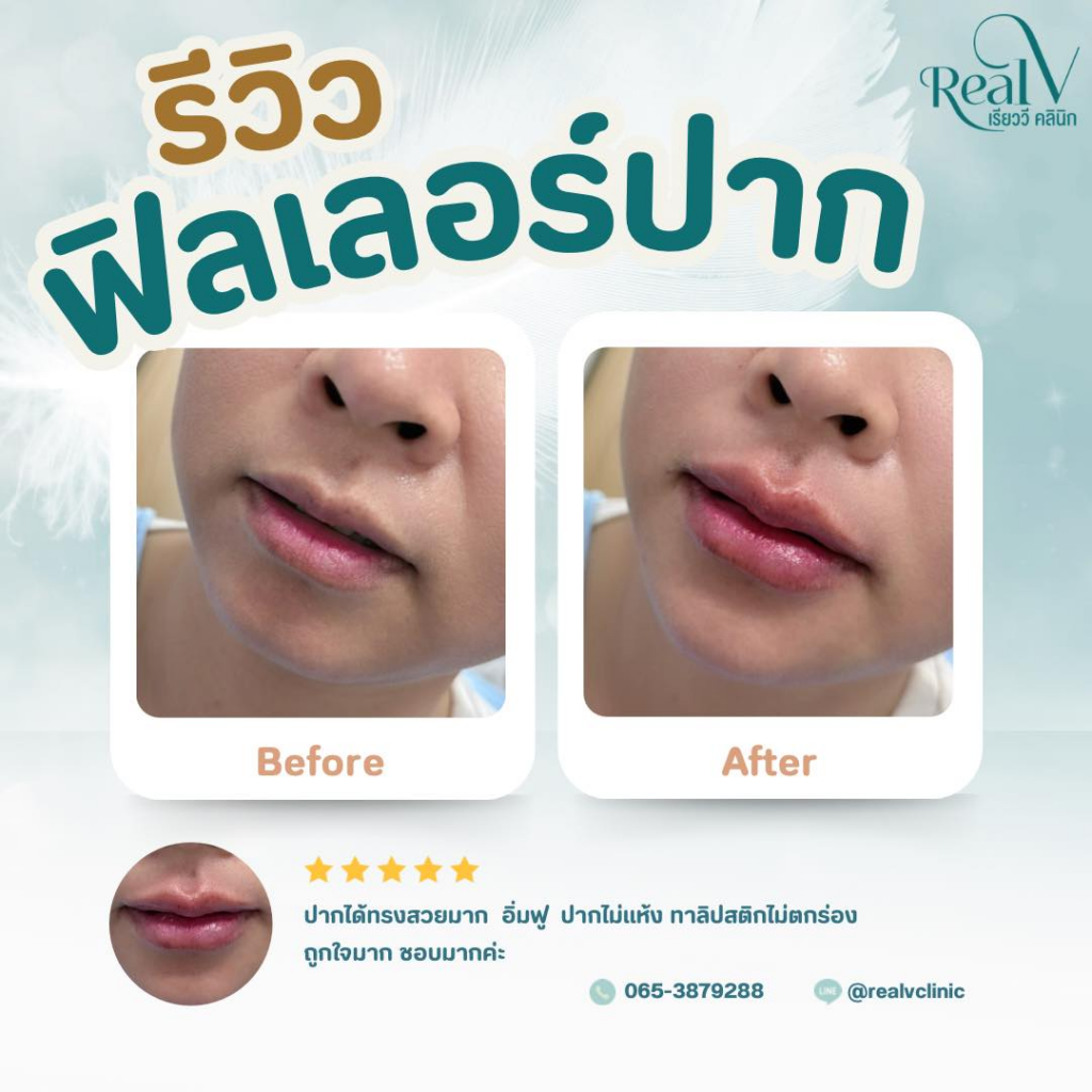 รีวิวคลินิกเสริมความงามกาฬสินธุ์ที่ RealV Clinic