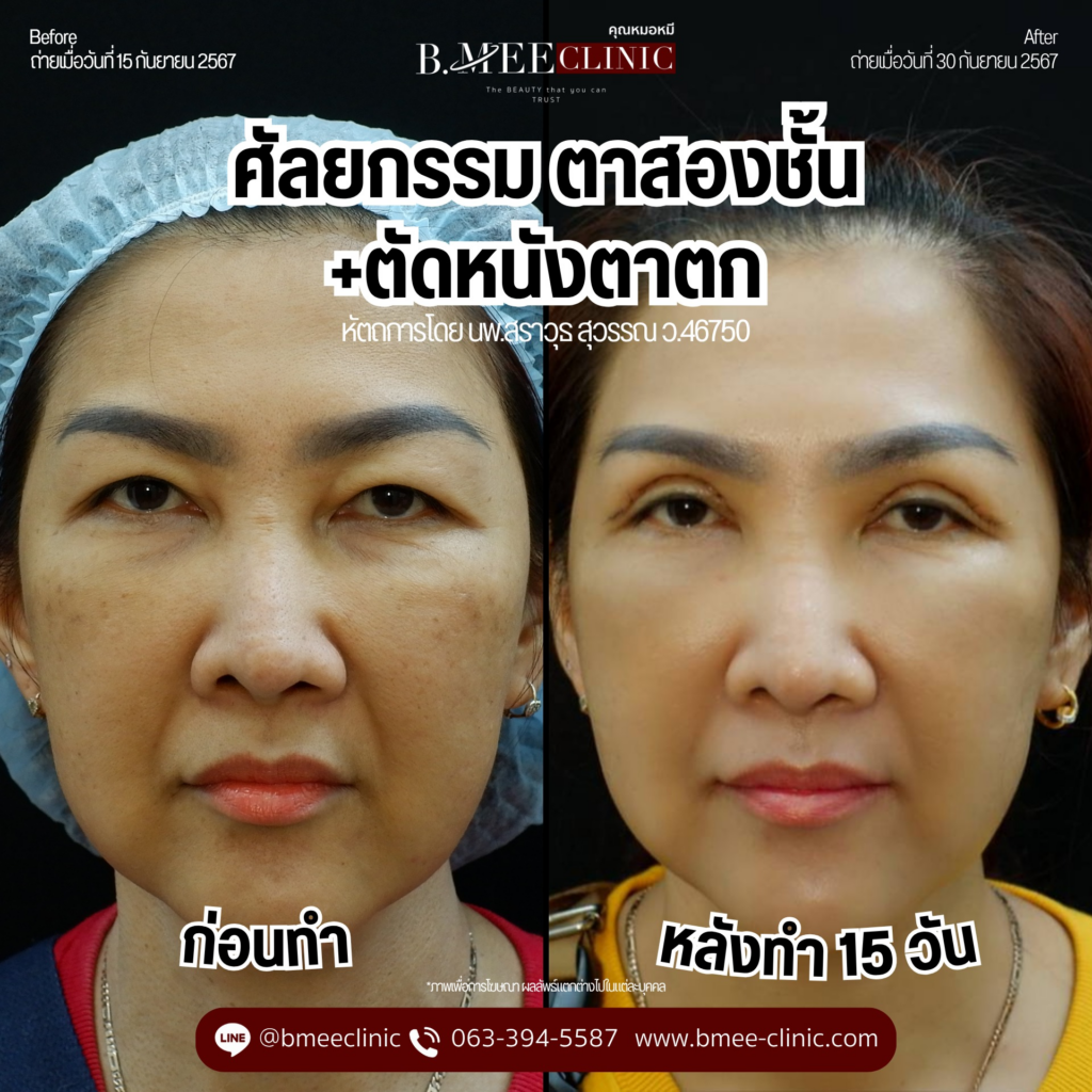 รีวิวคลินิกเสริมความงามขอนแก่นที่ บ้านหมีคลินิก