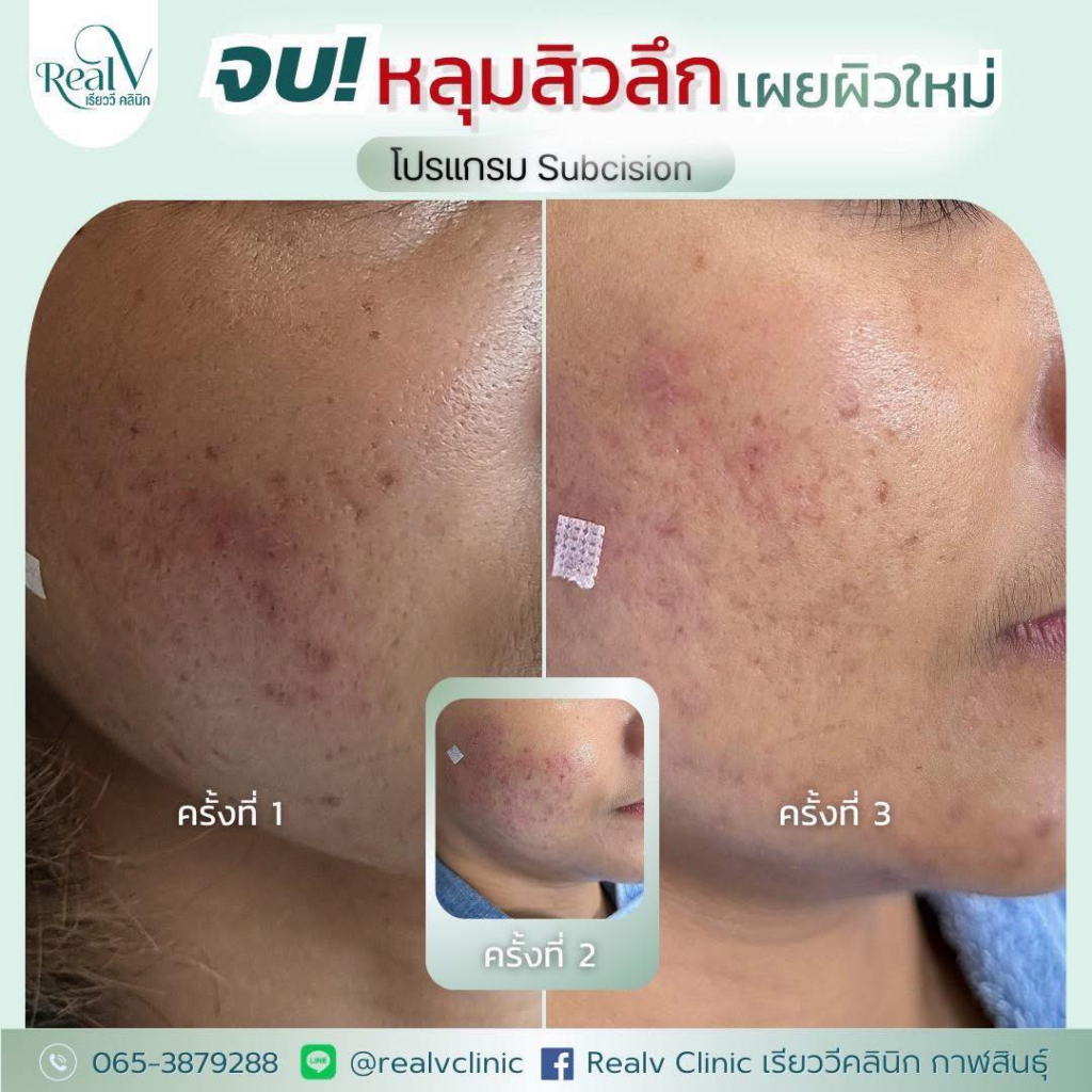 รีวิวคลินิกเสริมความงามกาฬสินธุ์ที่ RealV Clinic