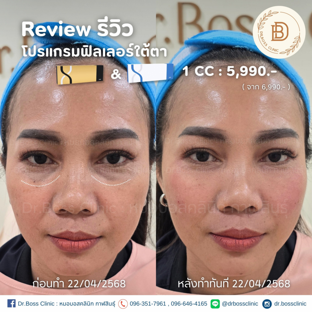 รีวิวคลินิกเสริมความงามกาฬสินธุ์ที่ Dr.Boss Clinic