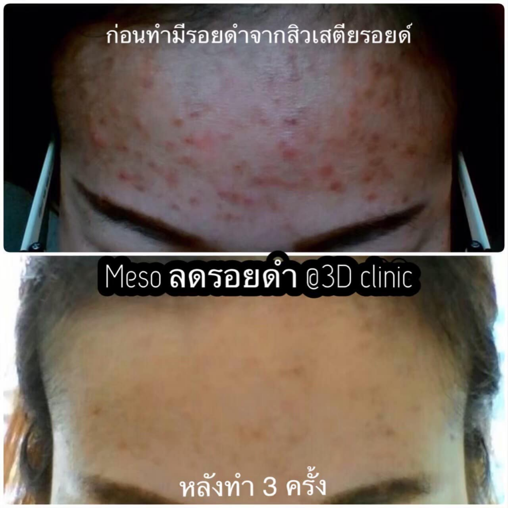 รีวิวคลินิกเสริมความงามกาฬสินธุ์ที่ 3D Clinic