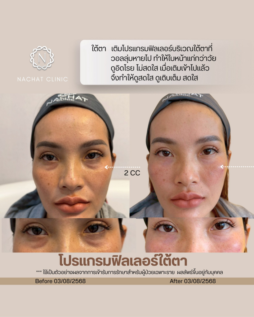 รีวิวคลินิกเสริมความงามกาฬสินธุ์ที่ Natcha Clinic