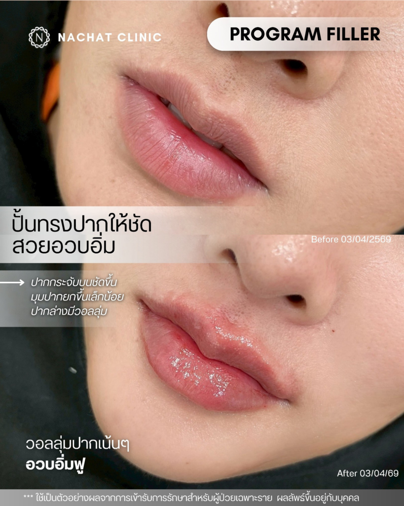 รีวิวคลินิกเสริมความงามกาฬสินธุ์ที่ Natcha Clinic
