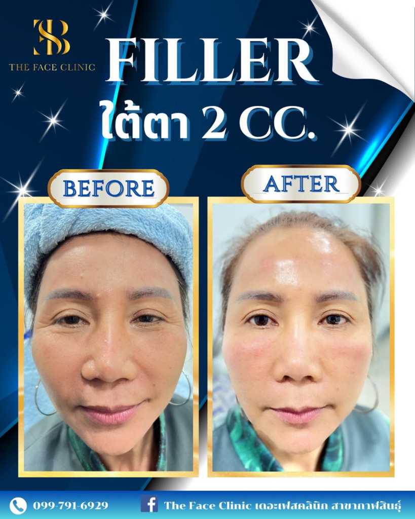 รีวิวคลินิกเสริมความงามกาฬสินธุ์ที่ The Face Clinic