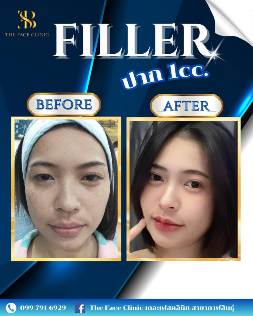 รีวิวคลินิกเสริมความงามกาฬสินธุ์ที่ The Face Clinic