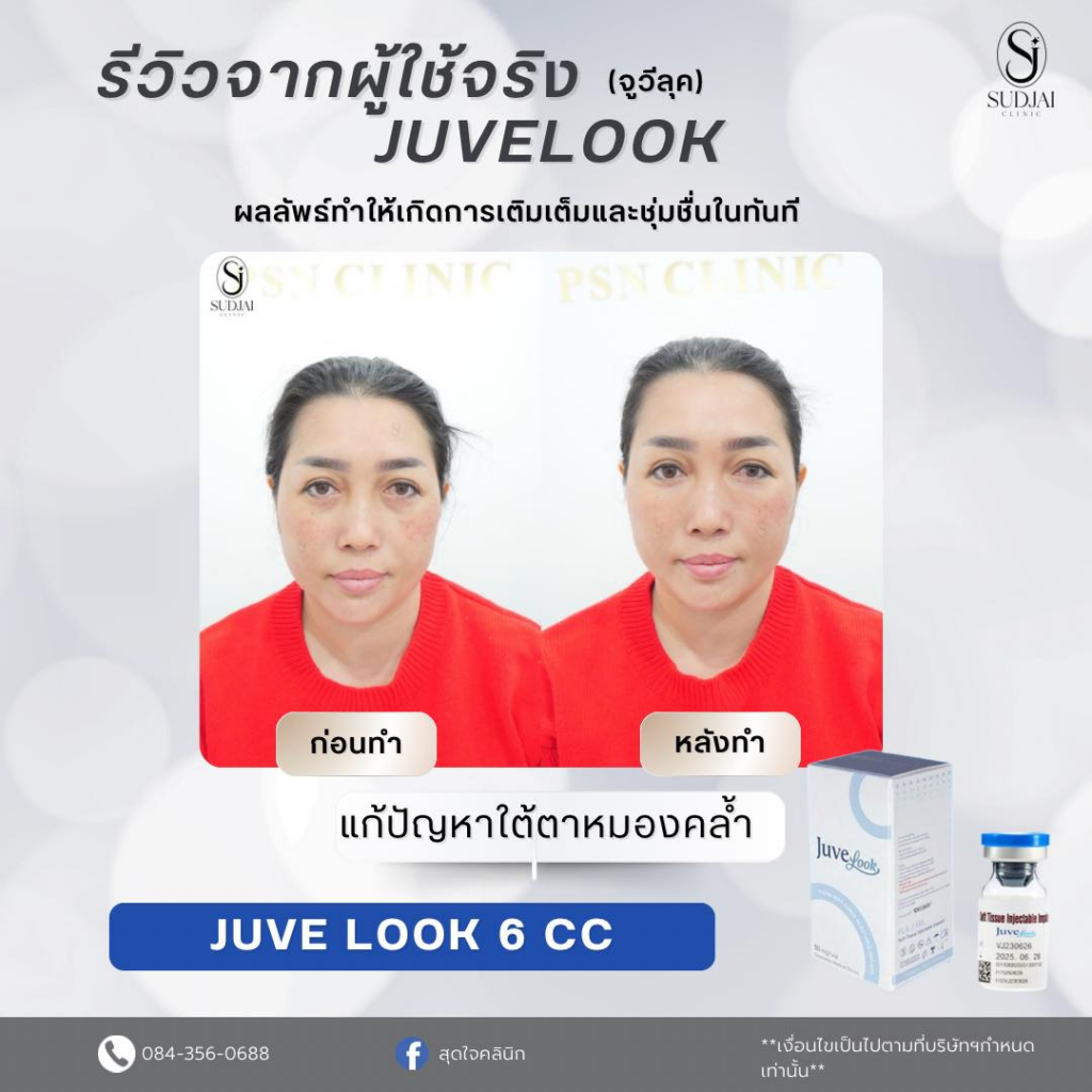 รีวิวคลินิกเสริมความงามกาฬสินธุ์ที่ สุดใจคลินิก
