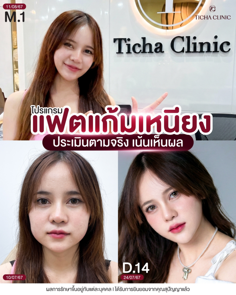 รีวิวคลินิกเสริมความงามขอนแก่นที่ Ticha Clinic