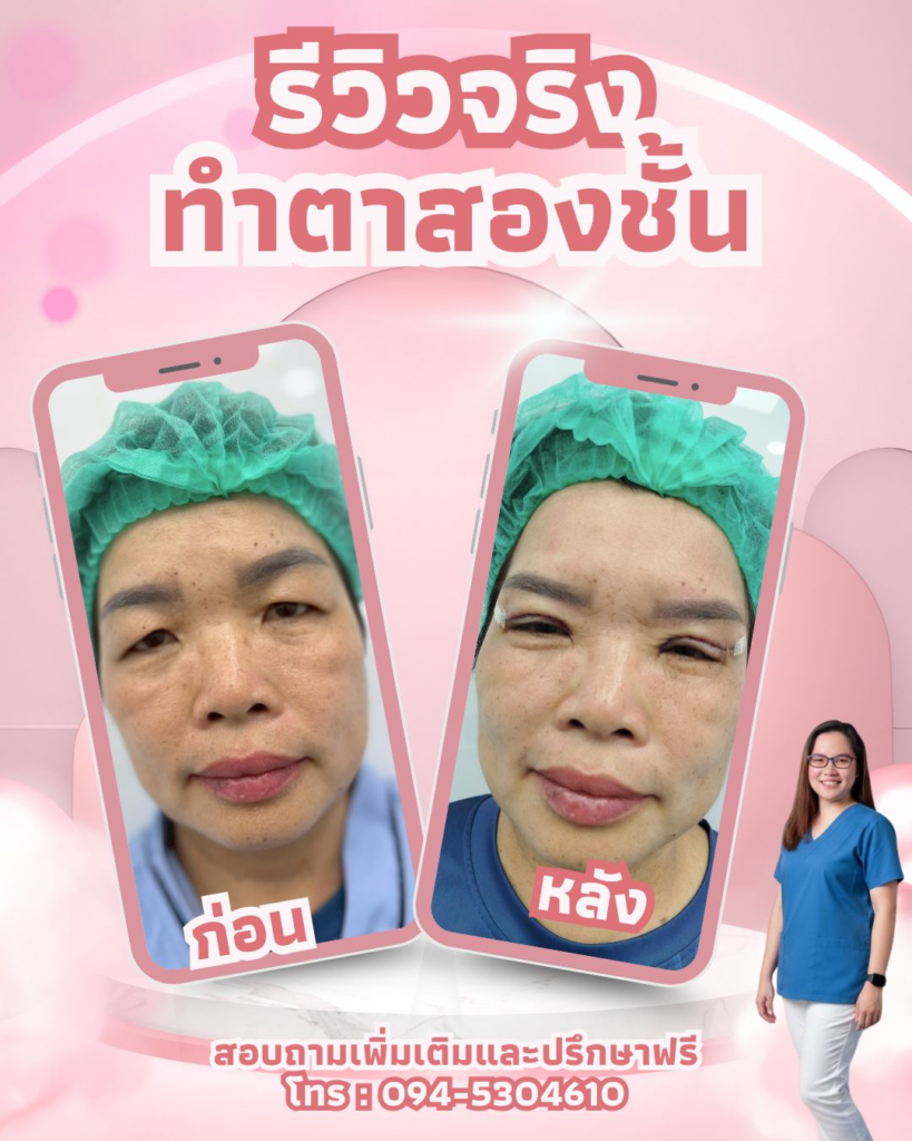 รีวิวคลินิกเสริมความงามกาฬสินธุ์ที่ JSC Clinic