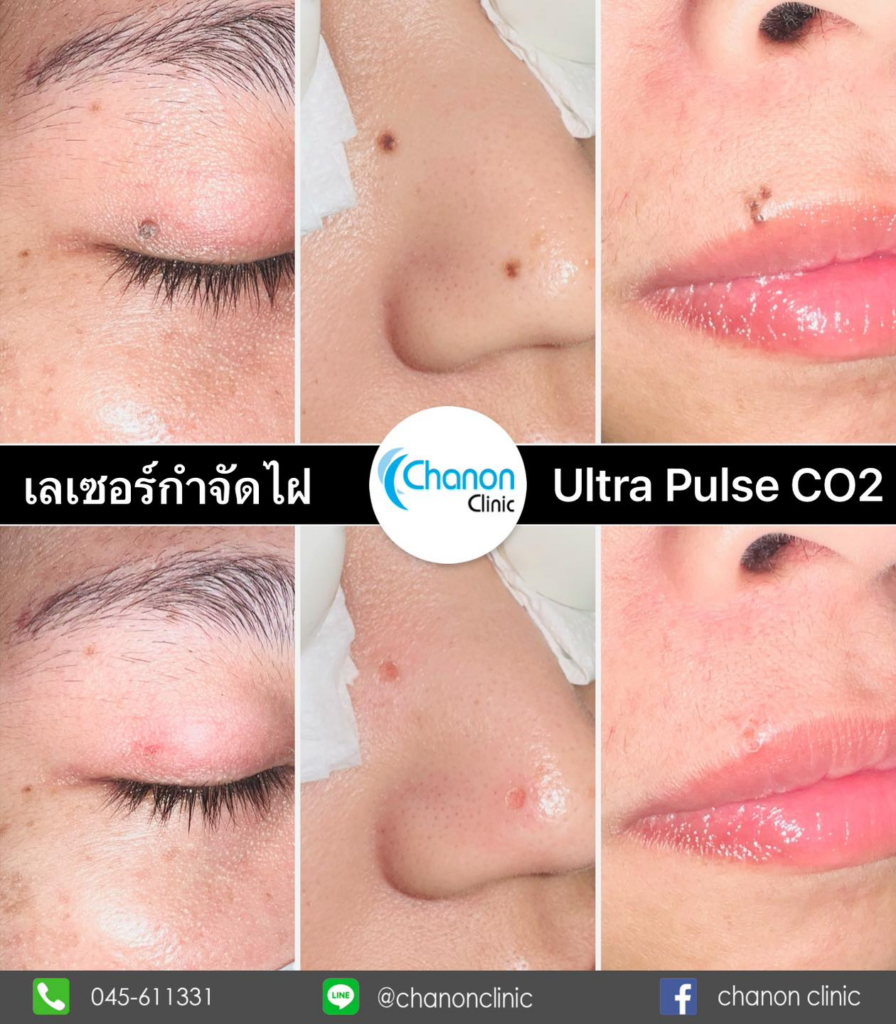 รีวิวคลินิกเสริมความงามศรีสะเกษที่ Chanon Clinic