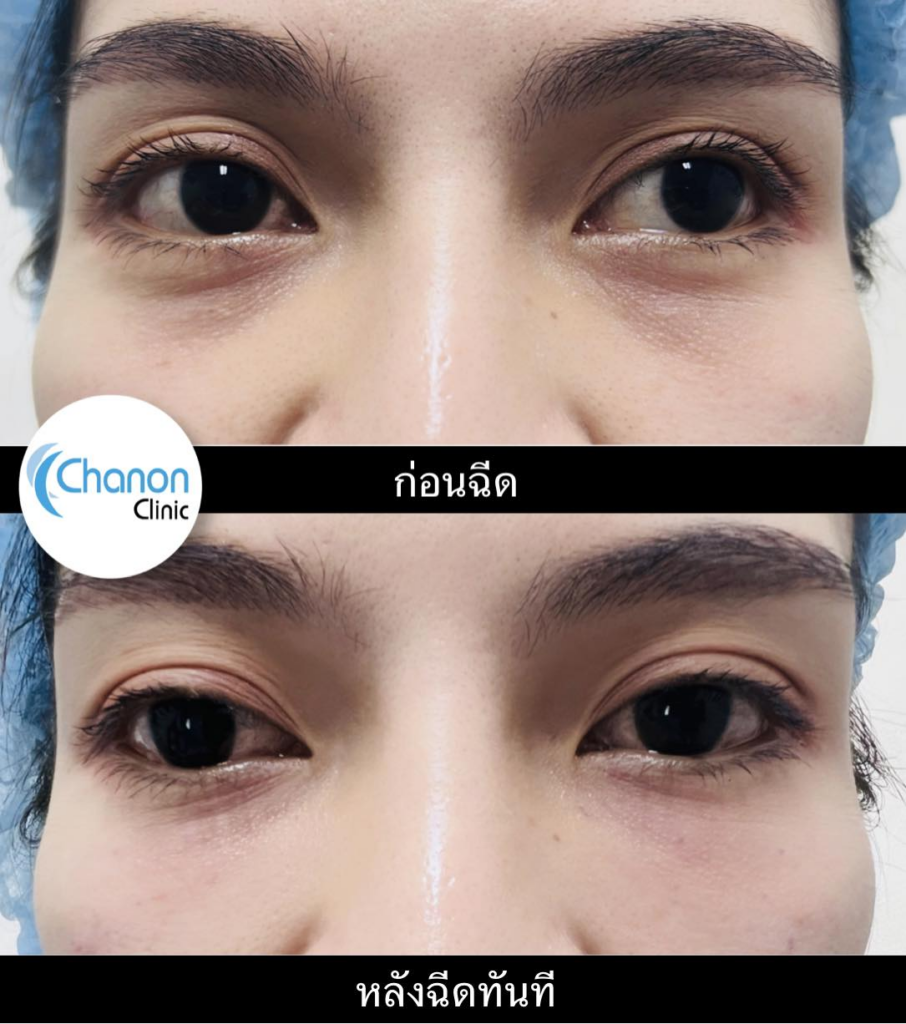 รีวิวคลินิกเสริมความงามศรีสะเกษที่ Chanon Clinic