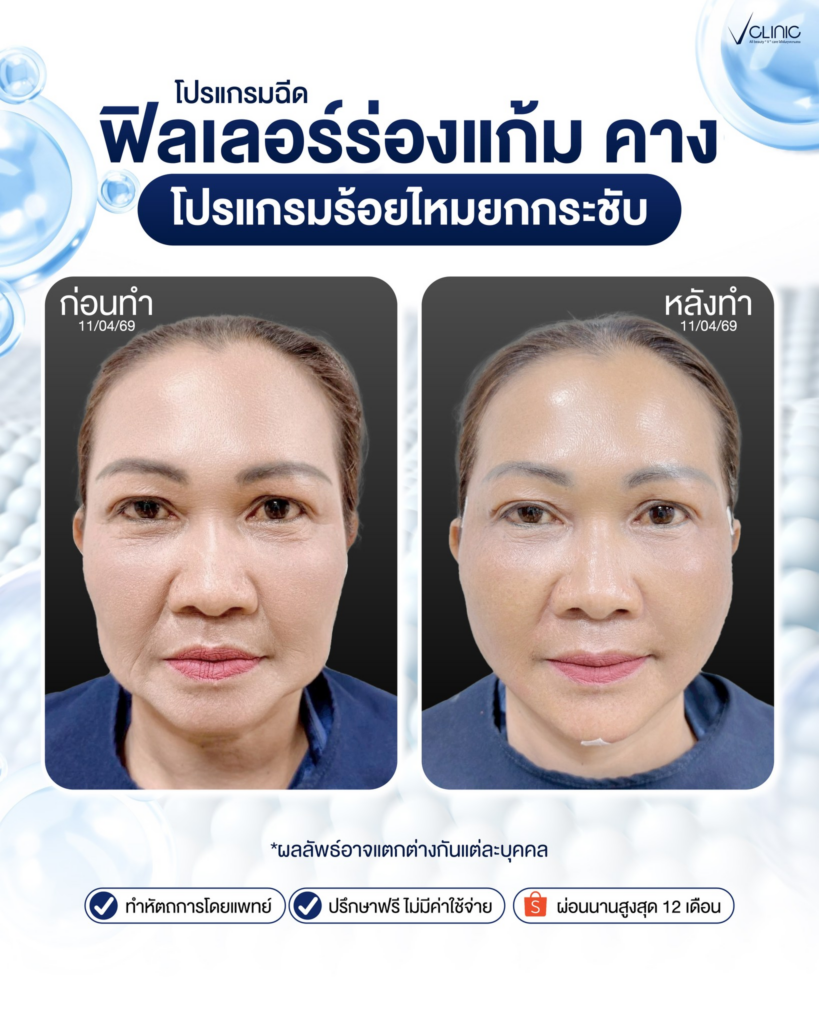รีวิวคลินิกเสริมความงามศรีสะเกษที่ V Clinic