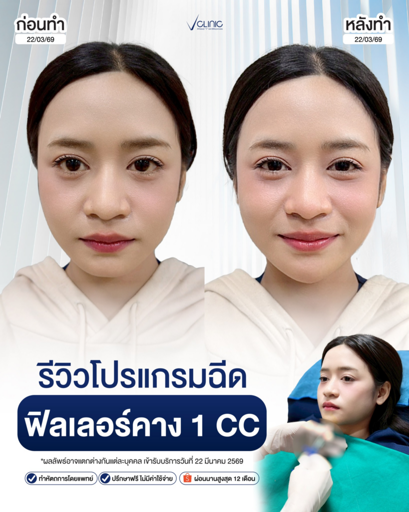 รีวิวคลินิกเสริมความงามศรีสะเกษที่ V Clinic