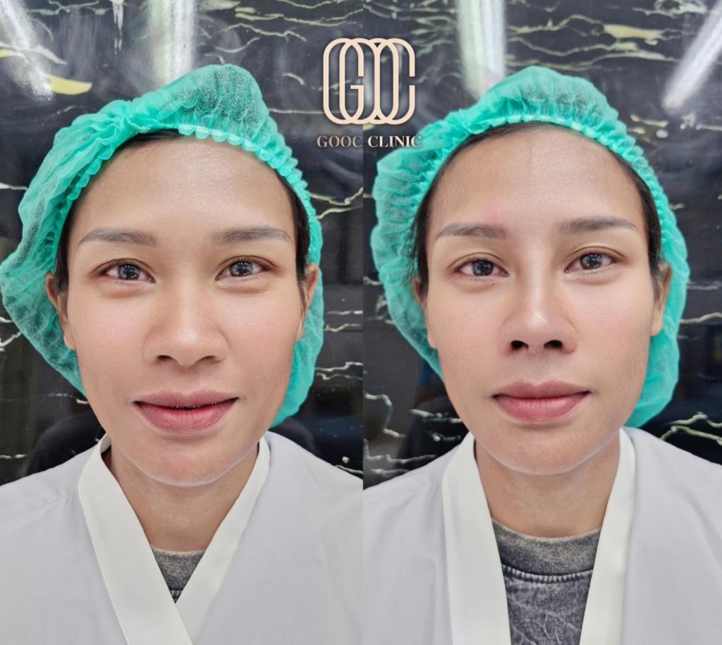 รีวิวคลินิกเสริมความงามศรีสะเกษที่ Gooc Clinic
