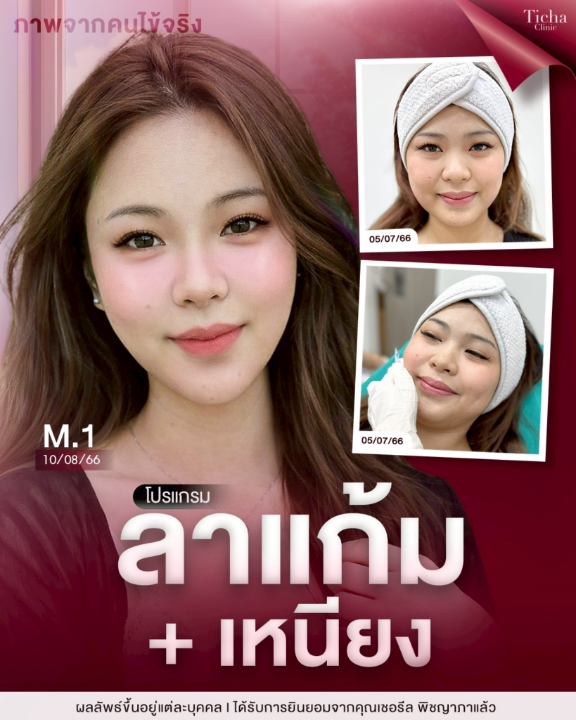 รีวิวคลินิกเสริมความงามขอนแก่นที่ Ticha Clinic