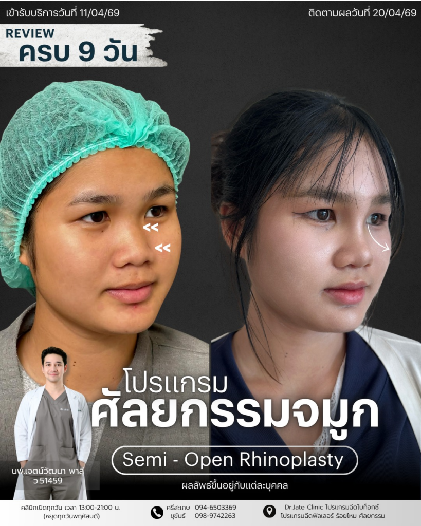 รีวิวคลินิกเสริมความงามศรีสะเกษที่ Dr.Jate Clinic