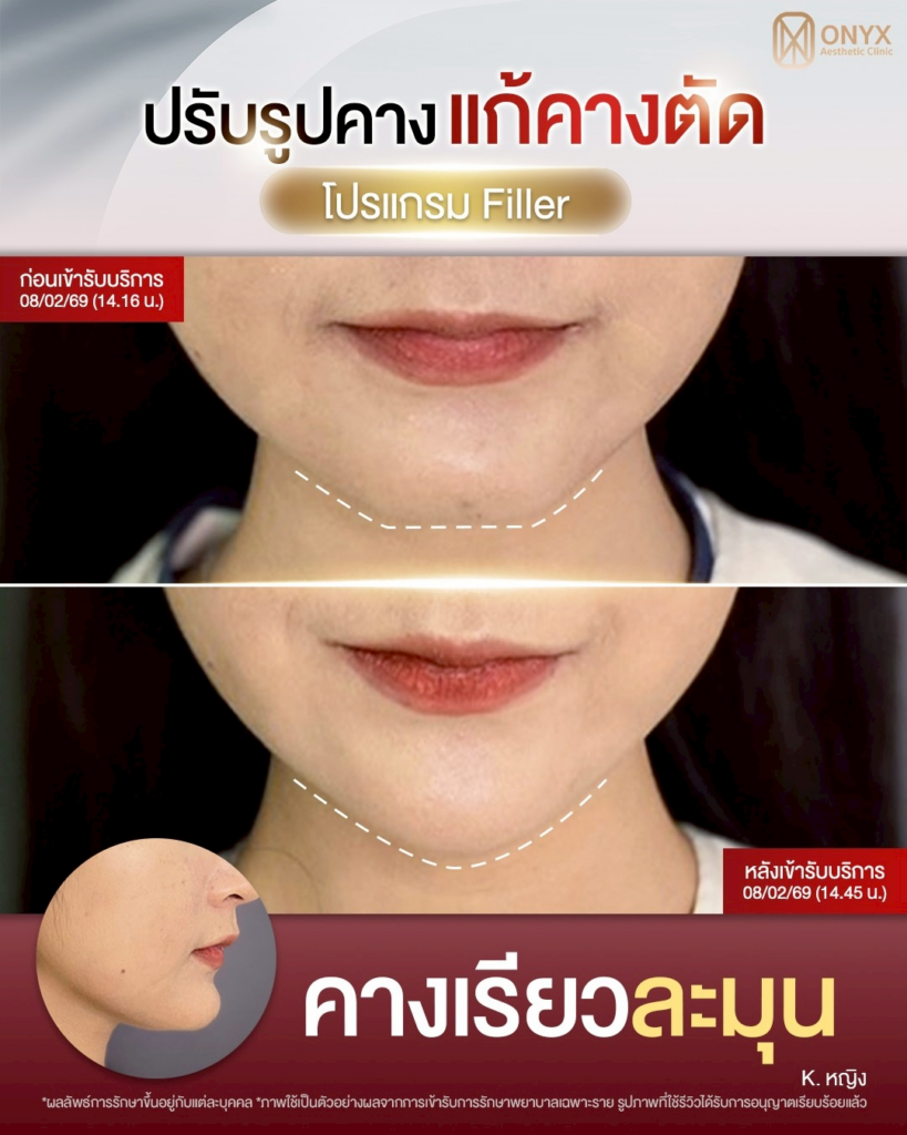 รีวิวคลินิกเสริมความงามศรีสะเกษที่ ONYX Clinic