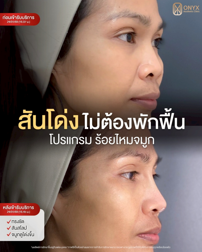 รีวิวคลินิกเสริมความงามศรีสะเกษที่ ONYX Clinic