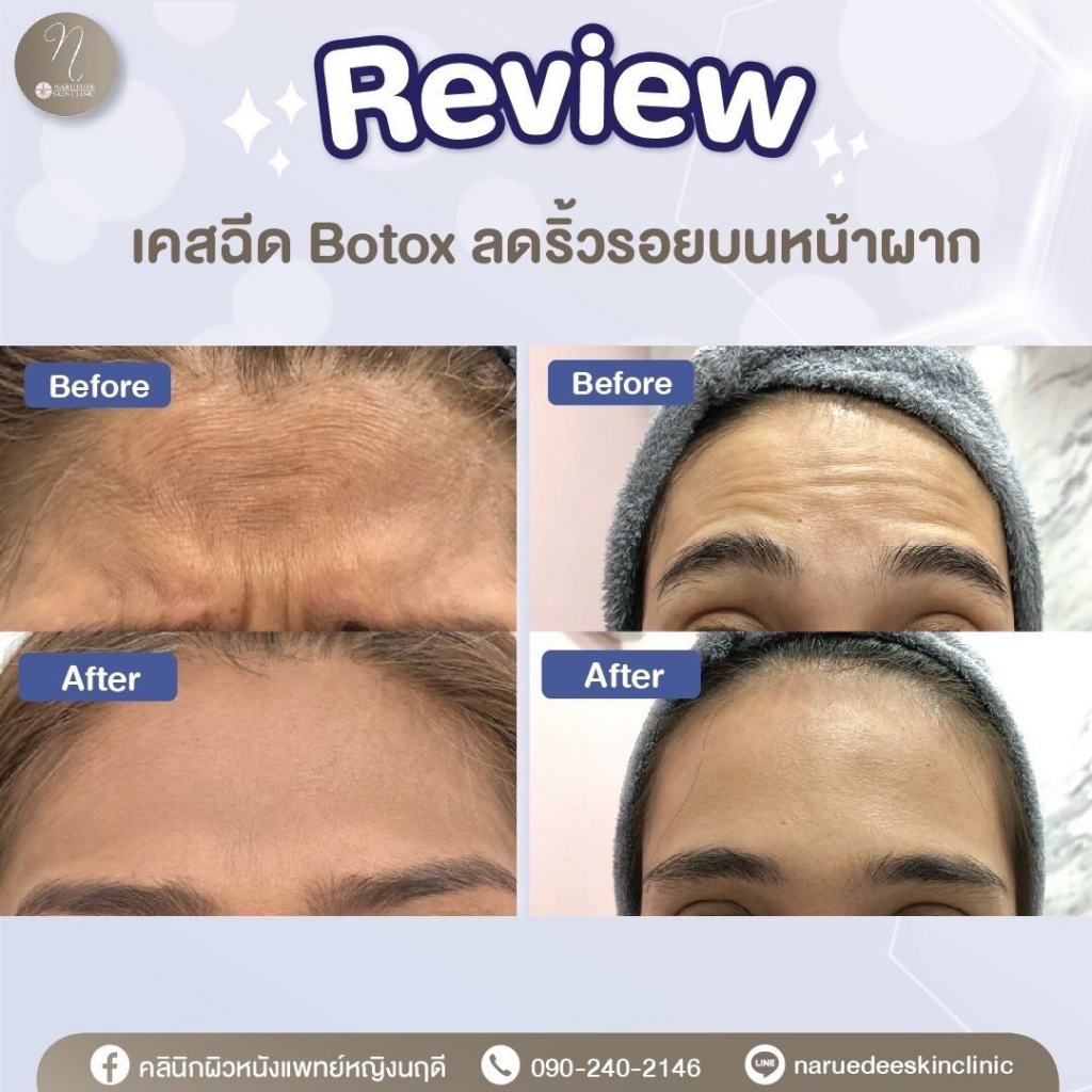 รีวิวคลินิกเสริมความงามศรีสะเกษที่ คลินิกผิวหนัง แพทย์หญิงนฤดี