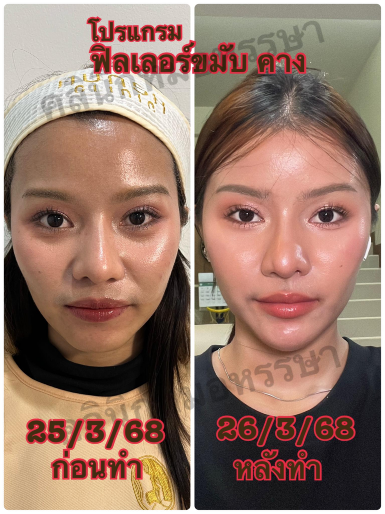 รีวิวคลินิกเสริมความงามศรีสะเกษที่ Hunsa Aesthetic Clinic