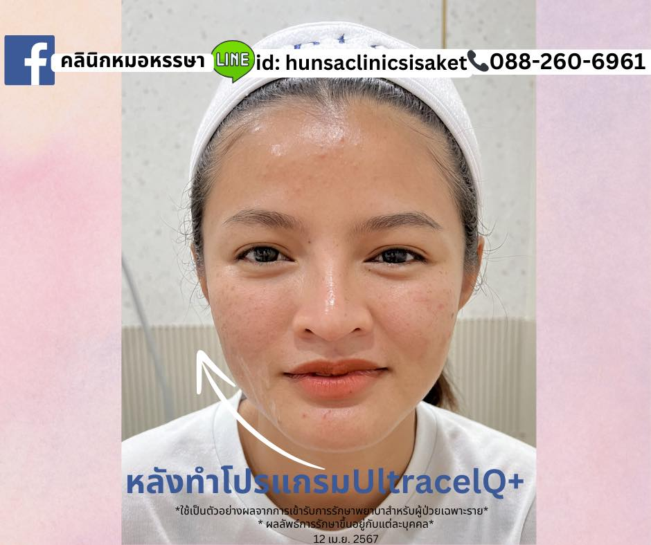 รีวิวคลินิกเสริมความงามศรีสะเกษที่ Hunsa Aesthetic Clinic