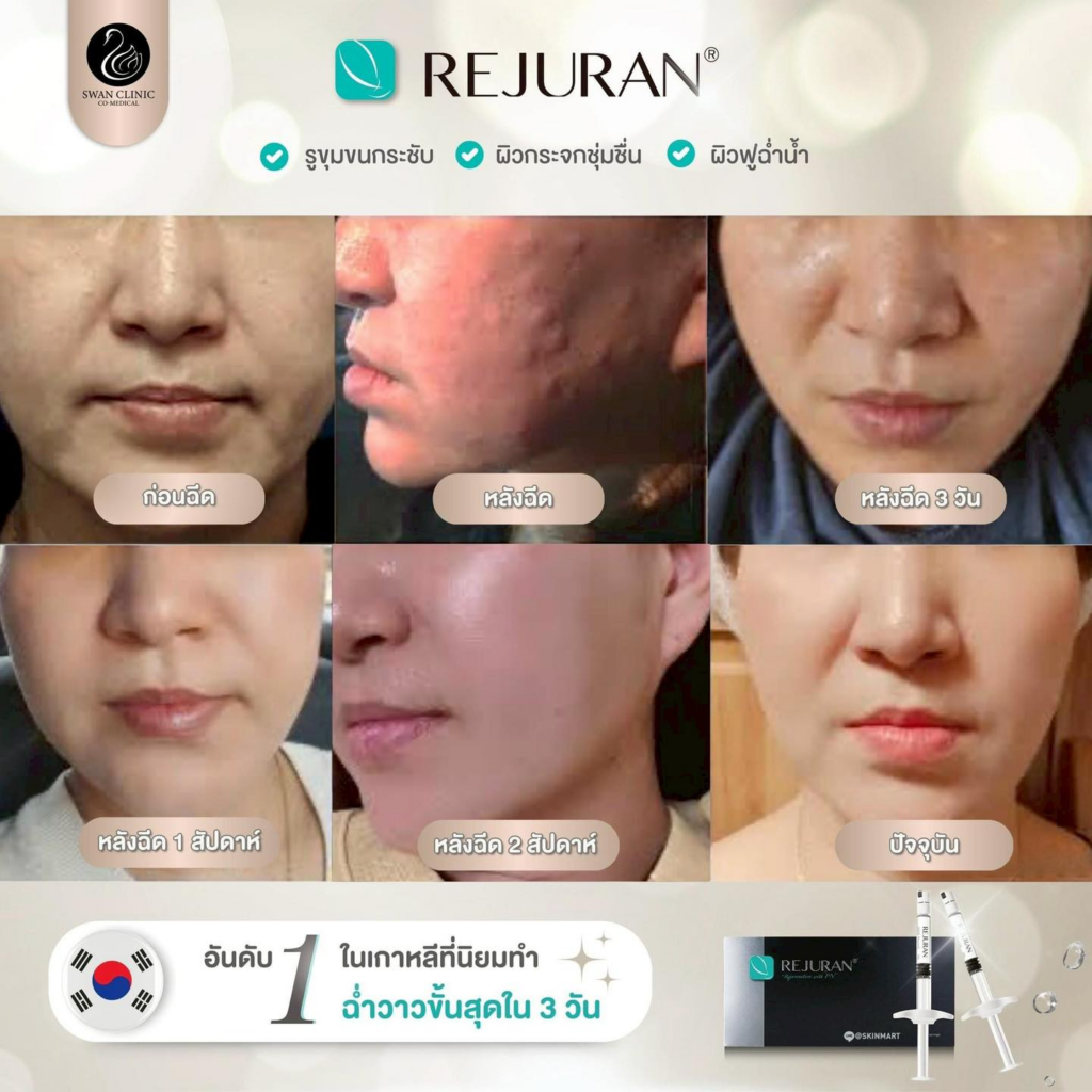 รีวิวคลินิกเสริมความงามขอนแก่นที่ SWAN CLINIC Co-Medical