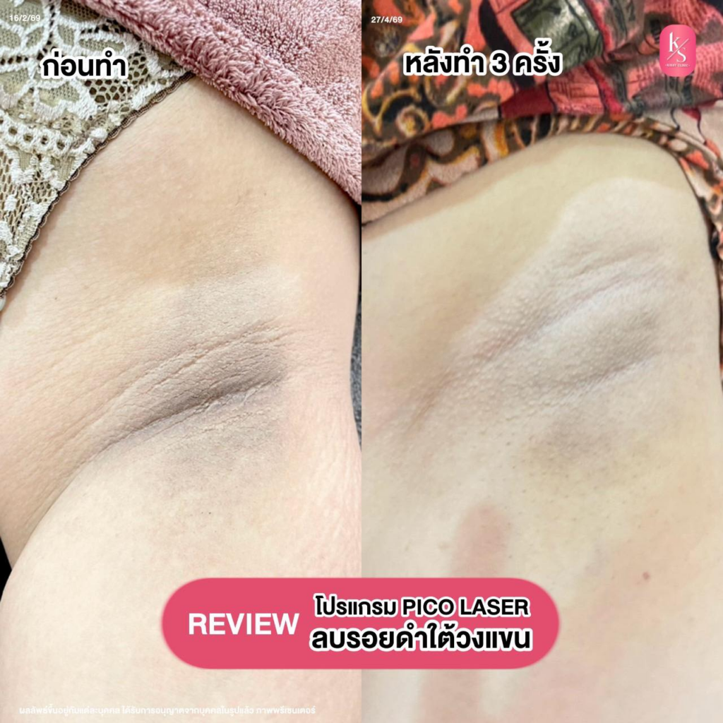 รีวิวคลินิกเสริมความงามศรีสะเกษที่ Kissy Clinic