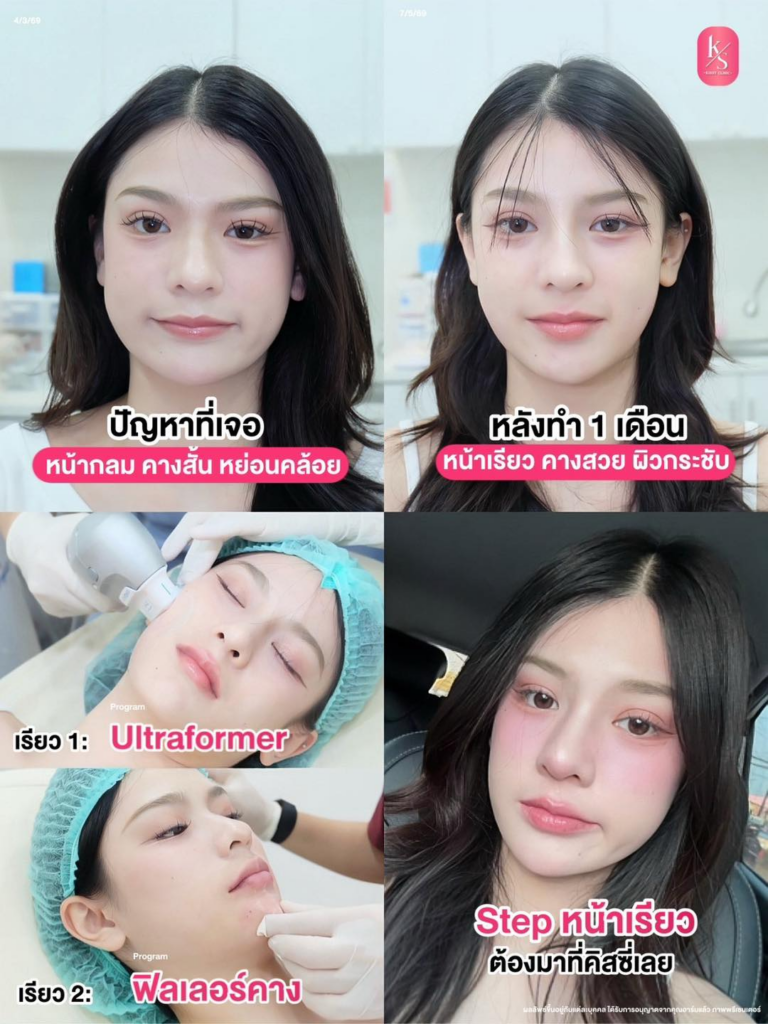 รีวิวคลินิกเสริมความงามศรีสะเกษที่ Kissy Clinic