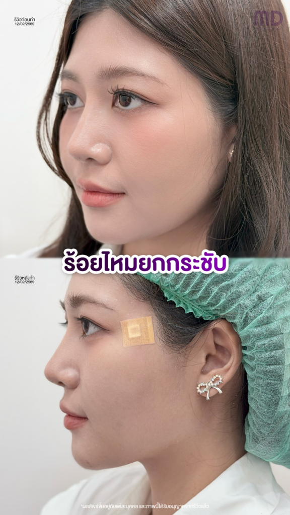 รีวิวคลินิกเสริมความงามขอนแก่นที่ MD Clinic