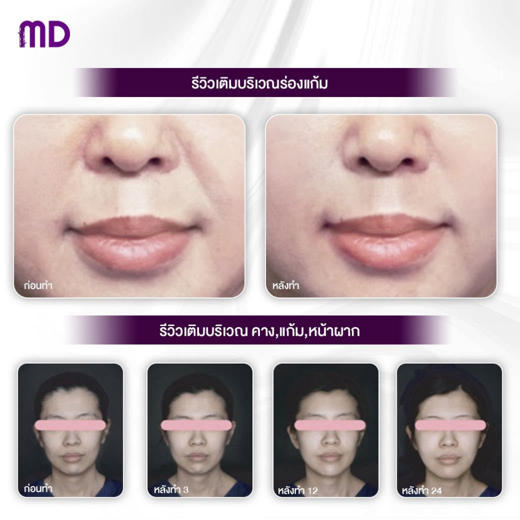 รีวิวคลินิกเสริมความงาม อุดรธานีที่ Md Clinic