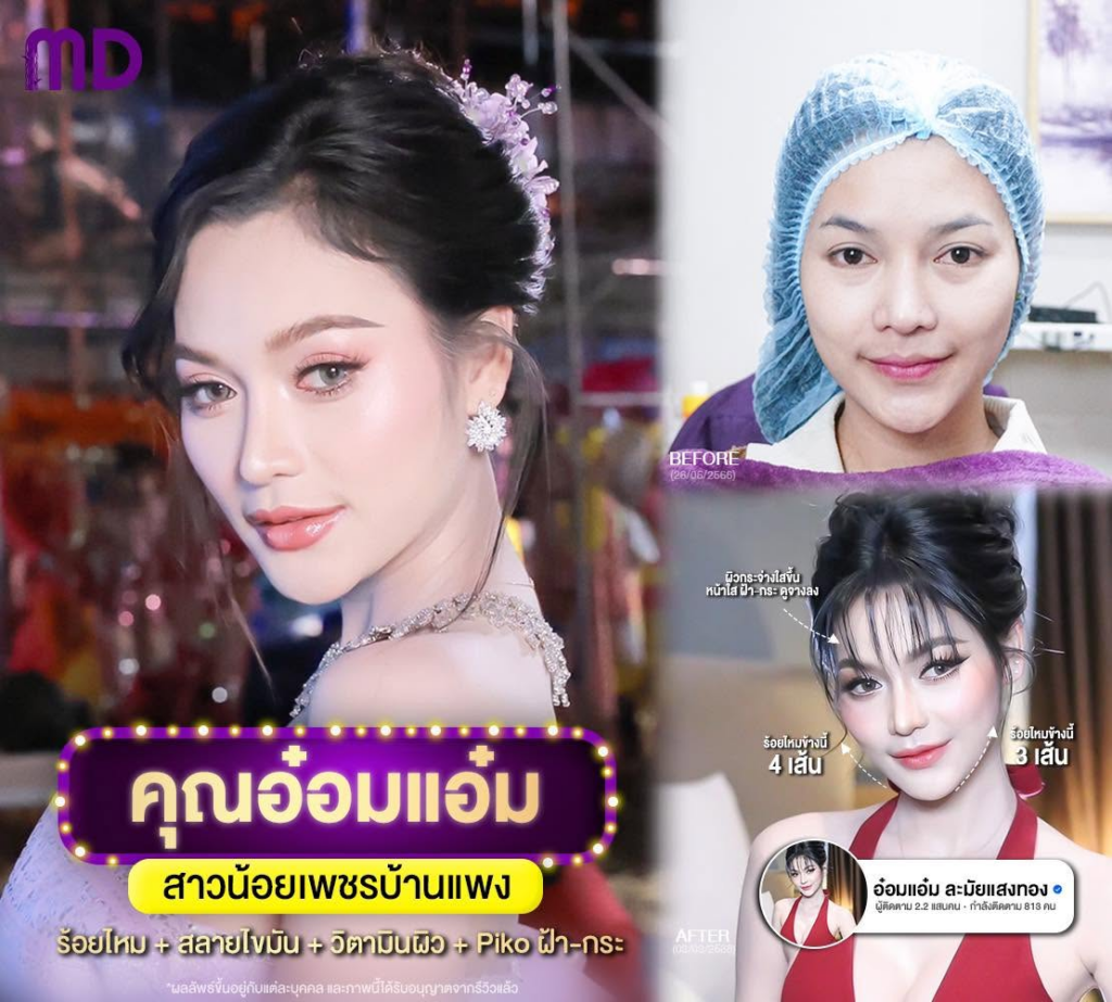รีวิวคลินิกเสริมความงาม อุดรธานีที่ Md Clinic