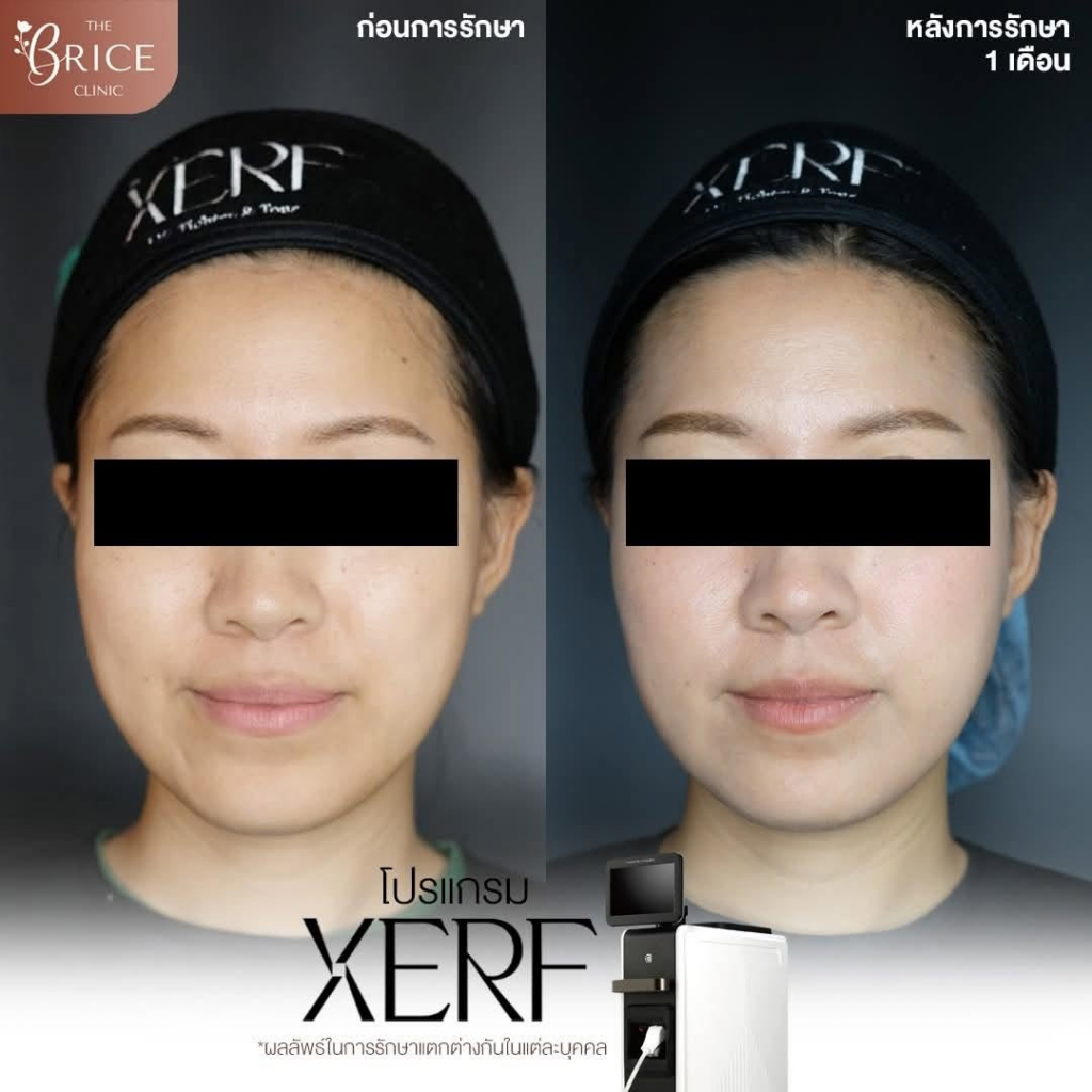 รีวิวคลินิกเสริมความงาม อุดรธานีที่ The Brice Clinic