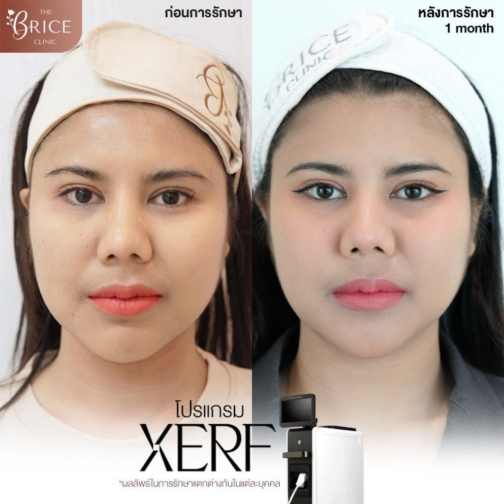 รีวิวคลินิกเสริมความงาม อุดรธานีที่ The Brice Clinic