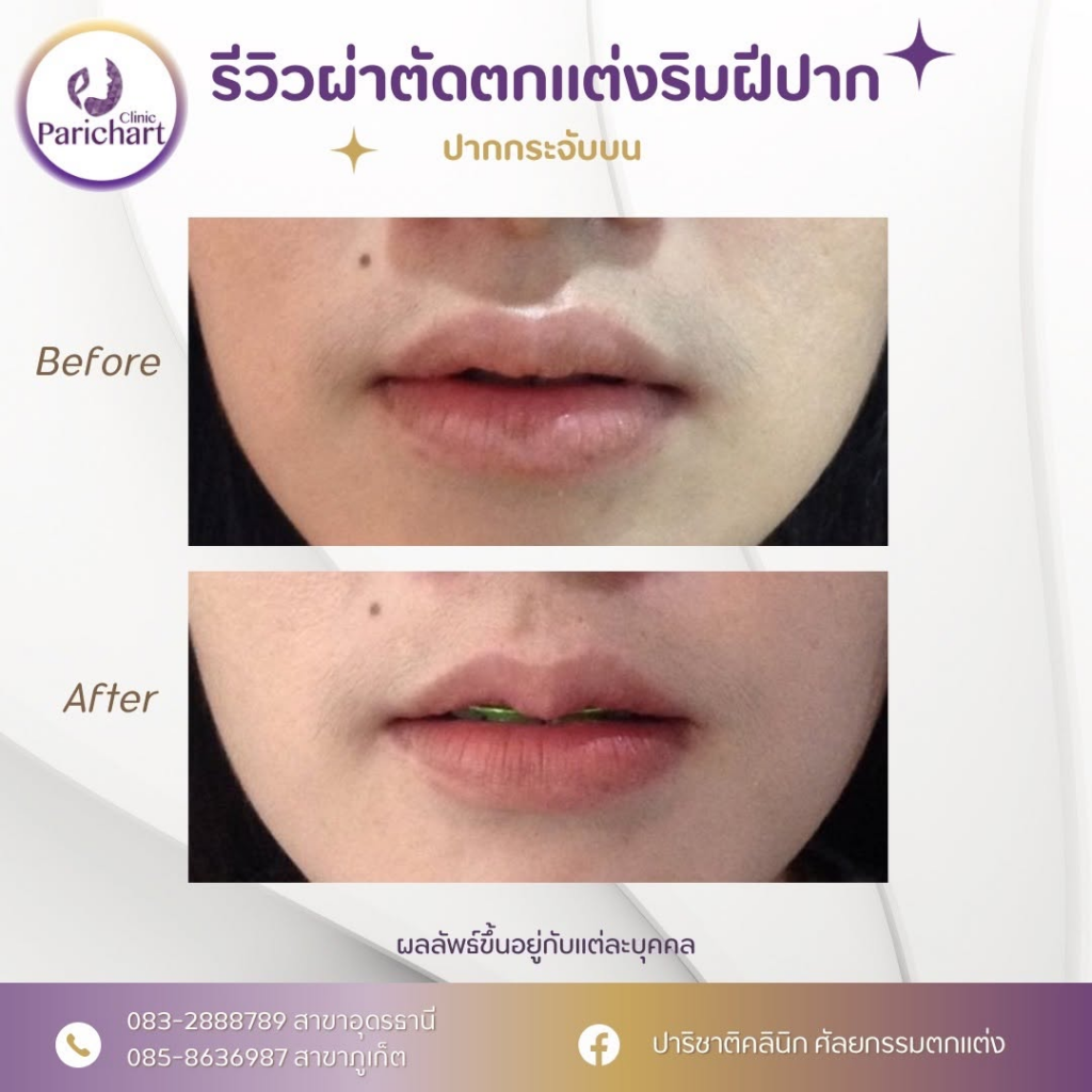 รีวิวคลินิกเสริมความงาม อุดรธานีที่ ปาริชาติคลินิก