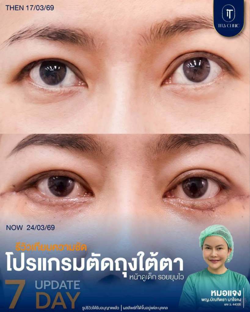 รีวิวคลินิกเสริมความงาม อุดรธานีที่ Tita Clinic