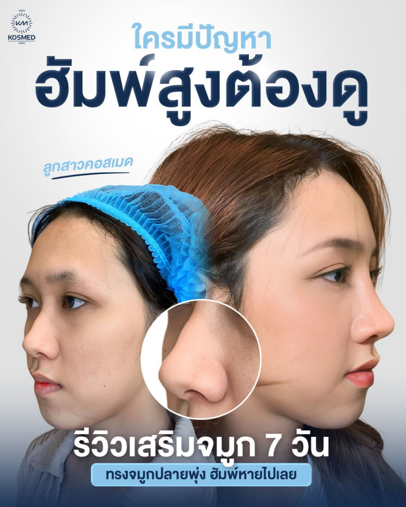 รีวิวคลินิกเสริมความงาม อุดรธานีที่ Kosmed Clinic