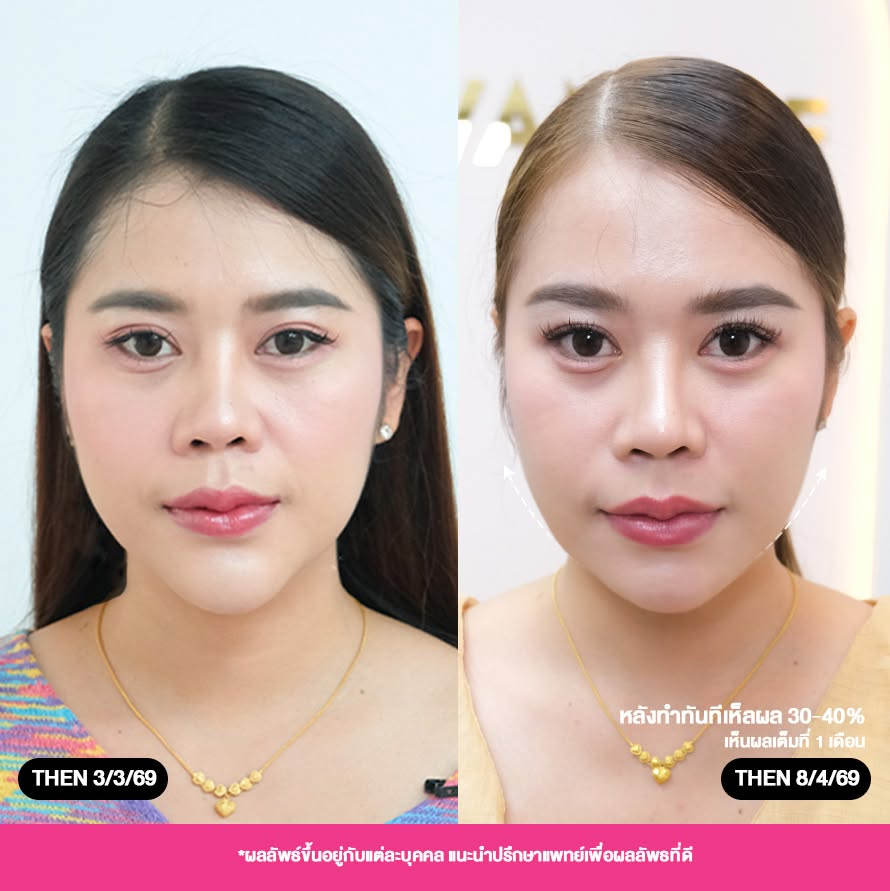 รีวิวคลินิกเสริมความงาม อุดรธานีที่ Wandee Clinic