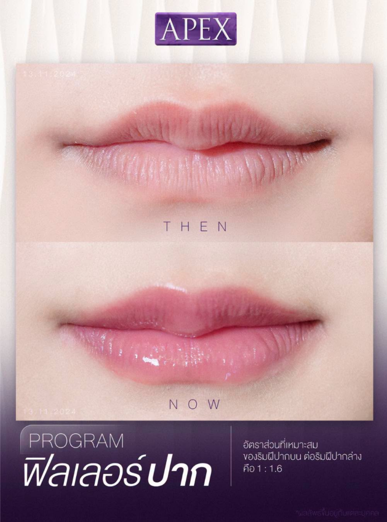 รีวิวคลินิกเสริมความงาม อุดรธานีที่ Apex Clinic สาขาอุดรธานี