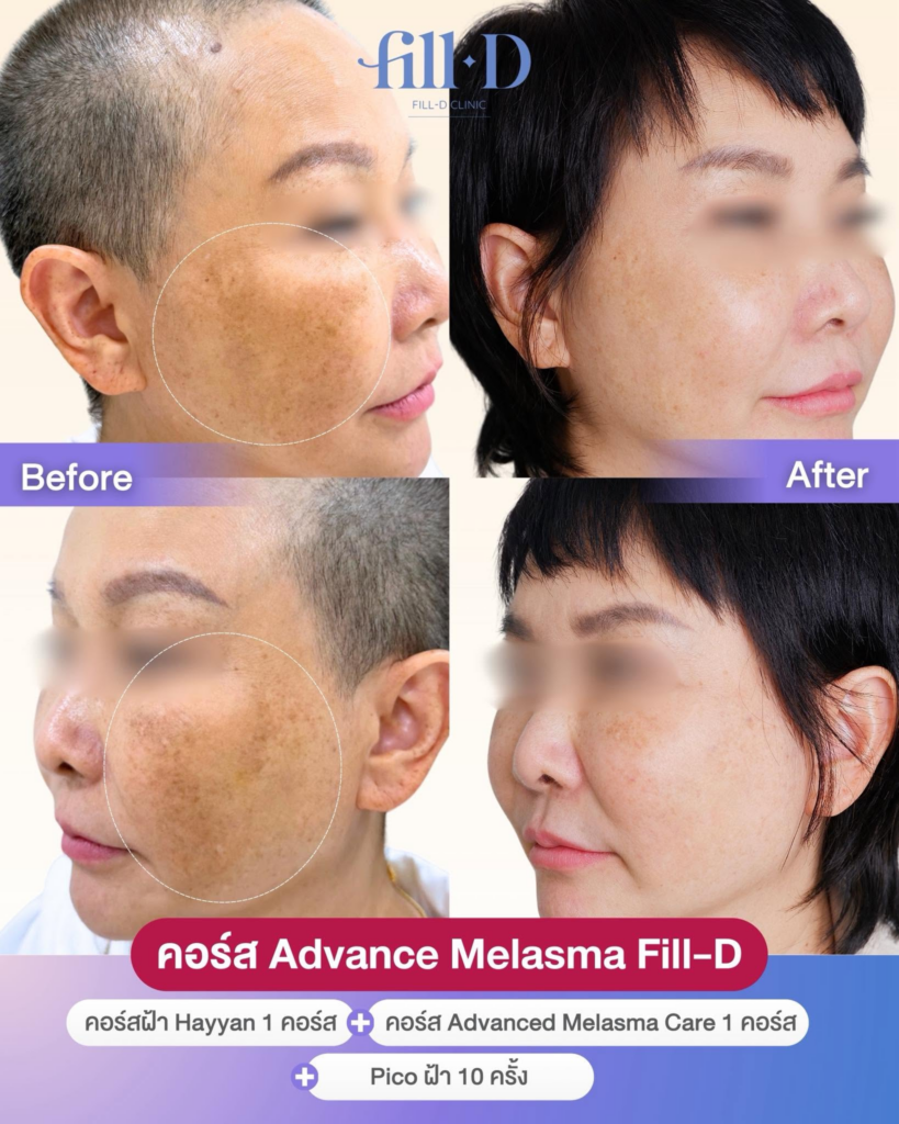 รีวิวคลินิกเสริมความงาม สุรินทร์ที่ Fill-D Clinic